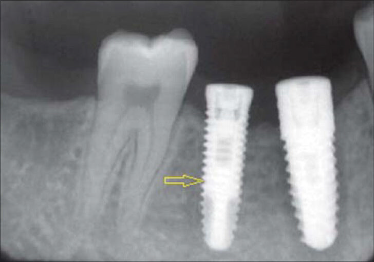 45-year-old male patient imaged for the evaluation of the implant. Periapical radiograph of the left mandibular posterior region shows the osseointegrated implant (arrows).